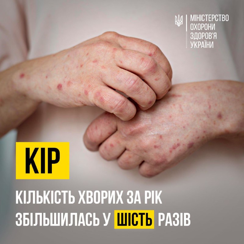 👨‍⚕️ У 2023 році на кір в Україні захворіло ушестеро більше людей, ніж у 2022 році