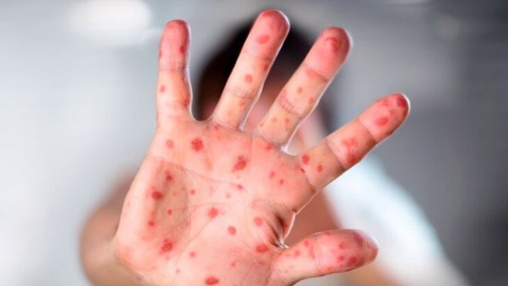 🦠В окупованому Маріуполі зафіксовані випадки кору
☝️У тимчасово окупованому місті на минулому тижні було зареєстровано кілька випадків кору 🦠В окупованому Маріуполі зафіксовані випадки кору
☝️У тимчасово окупованому місті на минулому тижні було зареєстровано кілька випадків кору